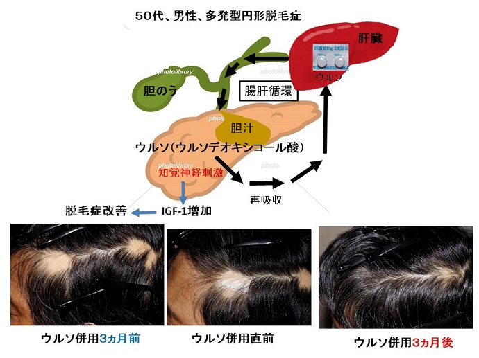 円形脱毛症　病院